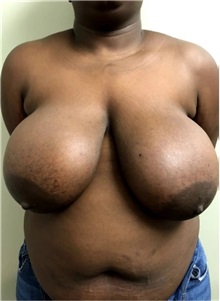 Breast Reduction Before Photo by M. Zakir Sabry, MD; New York, NY - Case 51171