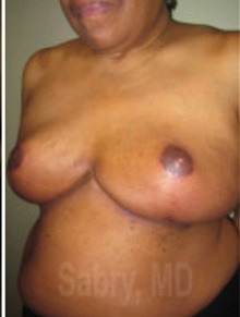 Breast Reduction After Photo by M. Zakir Sabry, MD; New York, NY - Case 51177