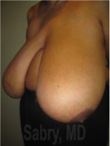 Breast Reduction Before Photo by M. Zakir Sabry, MD; New York, NY - Case 51177