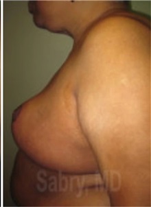 Breast Reduction After Photo by M. Zakir Sabry, MD; New York, NY - Case 51177
