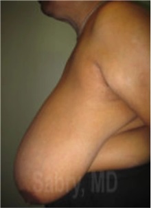 Breast Reduction Before Photo by M. Zakir Sabry, MD; New York, NY - Case 51177