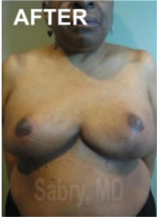 Breast Reduction After Photo by M. Zakir Sabry, MD; New York, NY - Case 51177