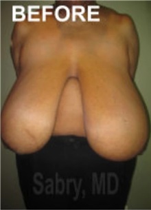 Breast Reduction Before Photo by M. Zakir Sabry, MD; New York, NY - Case 51177