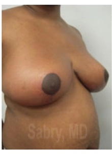 Breast Reduction After Photo by M. Zakir Sabry, MD; New York, NY - Case 51178