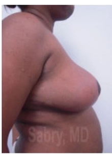 Breast Reduction After Photo by M. Zakir Sabry, MD; New York, NY - Case 51178