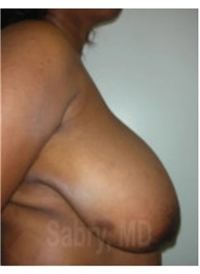 Breast Reduction Before Photo by M. Zakir Sabry, MD; New York, NY - Case 51178
