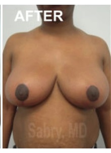 Breast Reduction After Photo by M. Zakir Sabry, MD; New York, NY - Case 51178