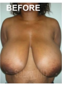 Breast Reduction Before Photo by M. Zakir Sabry, MD; New York, NY - Case 51178