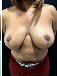 Breast Reduction After Photo by M. Zakir Sabry, MD; New York, NY - Case 51252