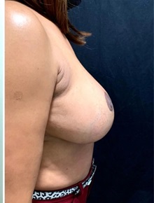 Breast Reduction After Photo by M. Zakir Sabry, MD; New York, NY - Case 51252