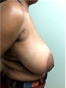 Breast Reduction Before Photo by M. Zakir Sabry, MD; New York, NY - Case 51252
