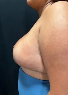 Breast Reduction After Photo by M. Zakir Sabry, MD; New York, NY - Case 51254