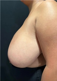 Breast Reduction Before Photo by M. Zakir Sabry, MD; New York, NY - Case 51254