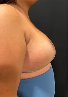 Breast Reduction After Photo by M. Zakir Sabry, MD; New York, NY - Case 51254