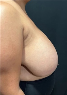 Breast Reduction Before Photo by M. Zakir Sabry, MD; New York, NY - Case 51254