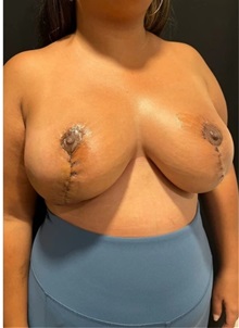 Breast Reduction After Photo by M. Zakir Sabry, MD; New York, NY - Case 51254