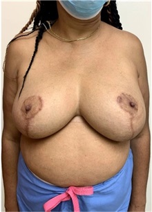 Breast Reduction After Photo by M. Zakir Sabry, MD; New York, NY - Case 51258