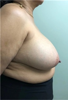 Breast Reduction Before Photo by M. Zakir Sabry, MD; New York, NY - Case 51258