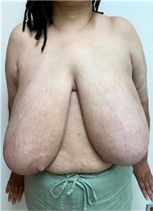 Breast Reduction Before Photo by M. Zakir Sabry, MD; New York, NY - Case 51260