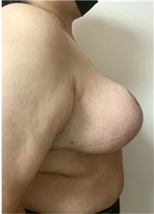 Breast Reduction After Photo by M. Zakir Sabry, MD; New York, NY - Case 51260