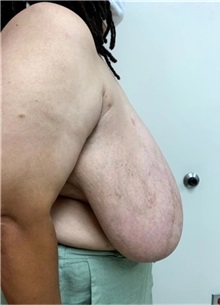 Breast Reduction Before Photo by M. Zakir Sabry, MD; New York, NY - Case 51260