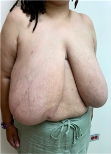 Breast Reduction Before Photo by M. Zakir Sabry, MD; New York, NY - Case 51260