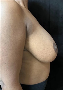 Breast Reduction Before Photo by M. Zakir Sabry, MD; New York, NY - Case 51263