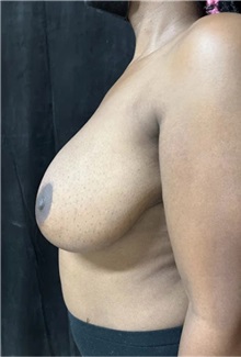 Breast Reduction Before Photo by M. Zakir Sabry, MD; New York, NY - Case 51263