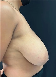 Breast Reduction Before Photo by M. Zakir Sabry, MD; New York, NY - Case 51296