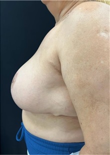 Breast Reduction After Photo by M. Zakir Sabry, MD; New York, NY - Case 51292