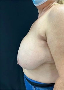 Breast Reduction Before Photo by M. Zakir Sabry, MD; New York, NY - Case 51292