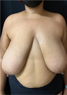 Breast Reduction Before Photo by M. Zakir Sabry, MD; New York, NY - Case 51294