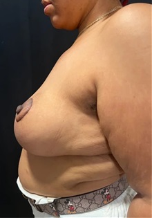 Breast Reduction After Photo by M. Zakir Sabry, MD; New York, NY - Case 51294
