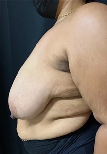 Breast Reduction Before Photo by M. Zakir Sabry, MD; New York, NY - Case 51294