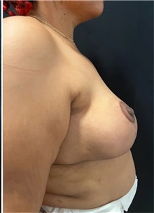 Breast Reduction After Photo by M. Zakir Sabry, MD; New York, NY - Case 51294