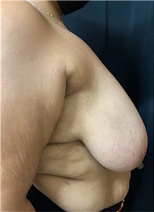 Breast Reduction Before Photo by M. Zakir Sabry, MD; New York, NY - Case 51294