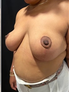 Breast Reduction After Photo by M. Zakir Sabry, MD; New York, NY - Case 51294