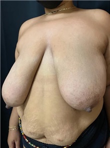 Breast Reduction Before Photo by M. Zakir Sabry, MD; New York, NY - Case 51294