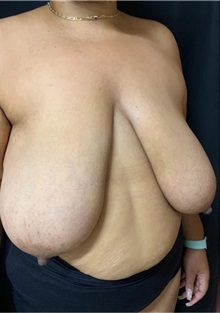 Breast Reduction Before Photo by M. Zakir Sabry, MD; New York, NY - Case 51294