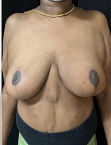 Breast Reduction After Photo by M. Zakir Sabry, MD; New York, NY - Case 51334