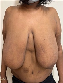 Breast Reduction Before Photo by M. Zakir Sabry, MD; New York, NY - Case 51334