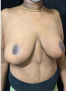 Breast Reduction After Photo by M. Zakir Sabry, MD; New York, NY - Case 51334