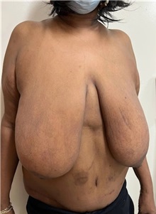 Breast Reduction Before Photo by M. Zakir Sabry, MD; New York, NY - Case 51334
