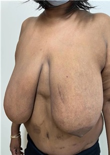Breast Reduction Before Photo by M. Zakir Sabry, MD; New York, NY - Case 51334