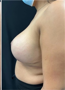Breast Reduction After Photo by M. Zakir Sabry, MD; New York, NY - Case 51331