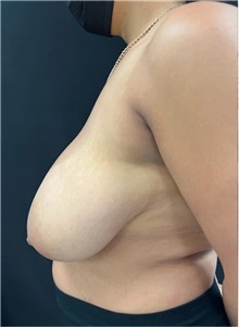 Breast Reduction Before Photo by M. Zakir Sabry, MD; New York, NY - Case 51331