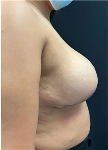 Breast Reduction After Photo by M. Zakir Sabry, MD; New York, NY - Case 51331