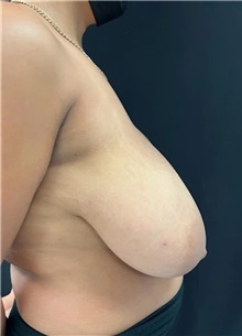 Breast Reduction Before Photo by M. Zakir Sabry, MD; New York, NY - Case 51331
