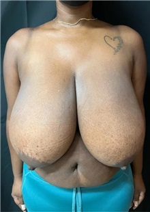 Breast Reduction Before Photo by M. Zakir Sabry, MD; New York, NY - Case 51336
