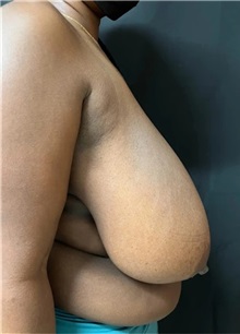 Breast Reduction Before Photo by M. Zakir Sabry, MD; New York, NY - Case 51336